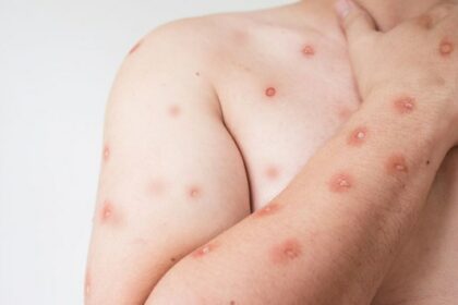 Primeira edição de informativo sobre cenário de casos de Mpox