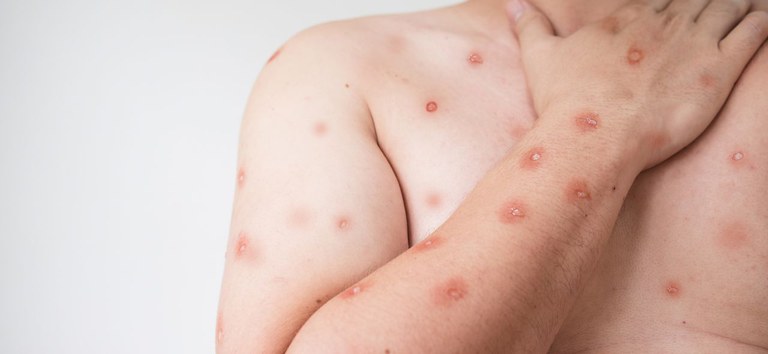 Primeira edição de informativo sobre cenário de casos de Mpox