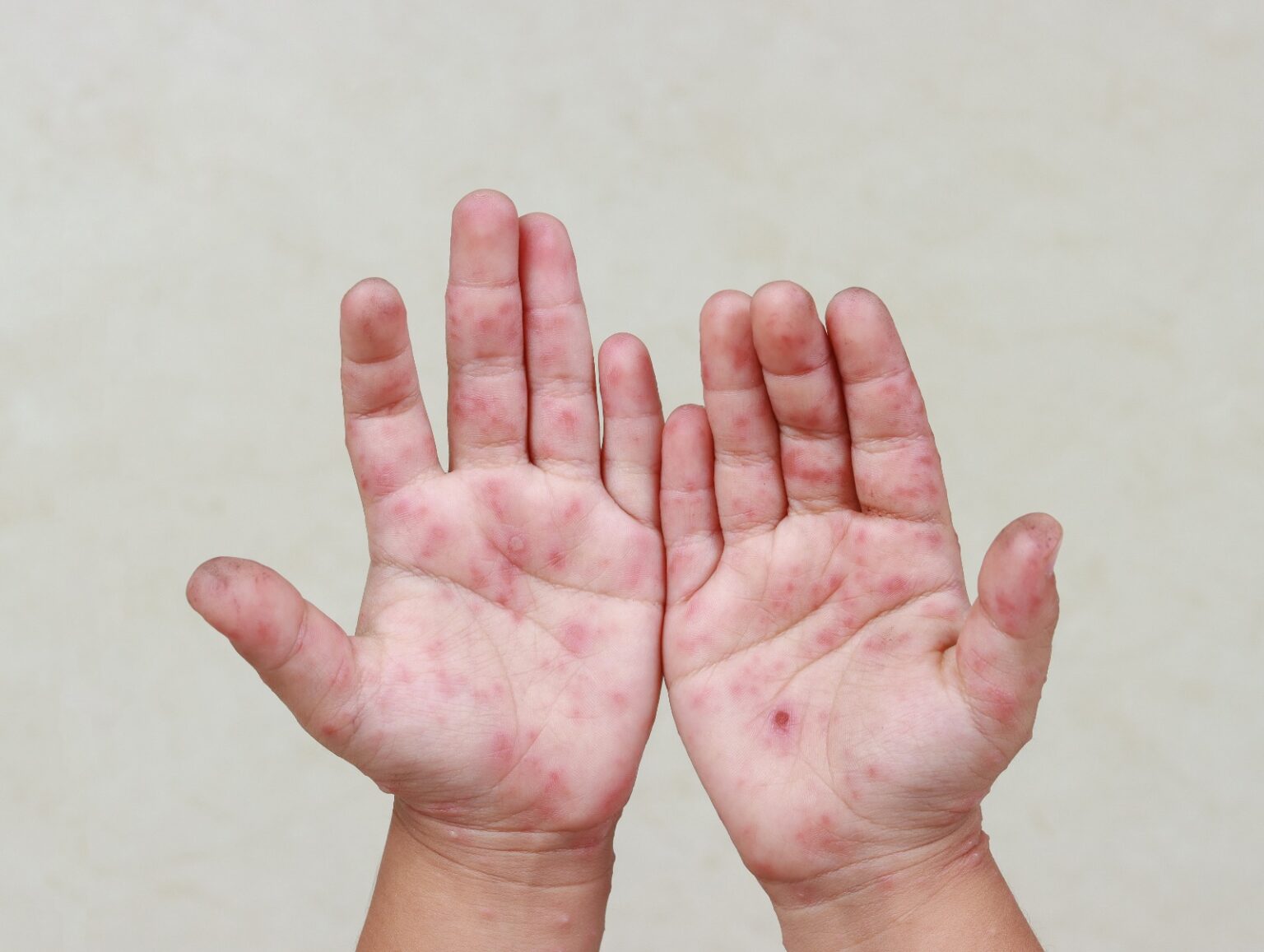 Cuidados para prevenir doença mão-pé-boca