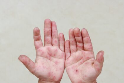 Cuidados para prevenir doença mão-pé-boca