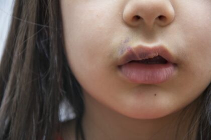 Comissão debate políticas públicas de atenção integral às pessoas com fissura labiopalatina
