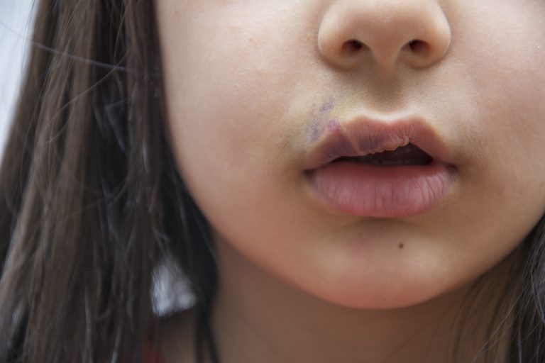 Comissão debate políticas públicas de atenção integral às pessoas com fissura labiopalatina